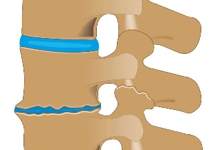 osteocondroza celei de-a 2-a părți a coloanei vertebrale, gradul 2)